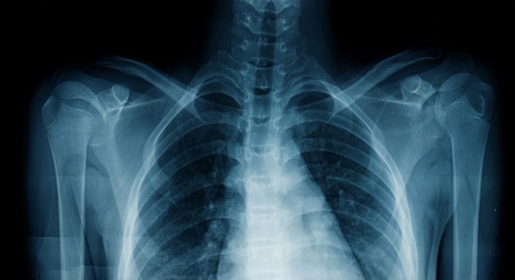 تعیین نژاد انسان از روی عکس اشعه ایکس با هوش مصنوعی