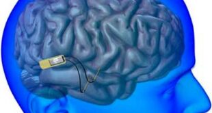 ایمپلنت های مغزی چیست؟ آیا می‌توانیم مغز را به کامپیوتر متصل کنیم؟
